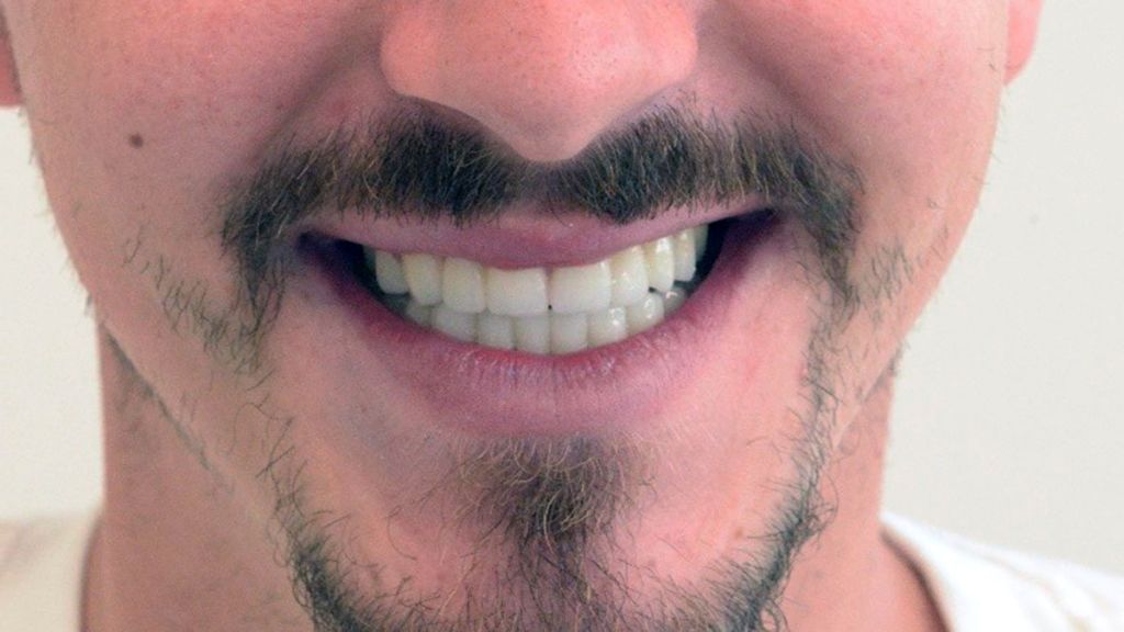 dentistra_prije_poslije_6a